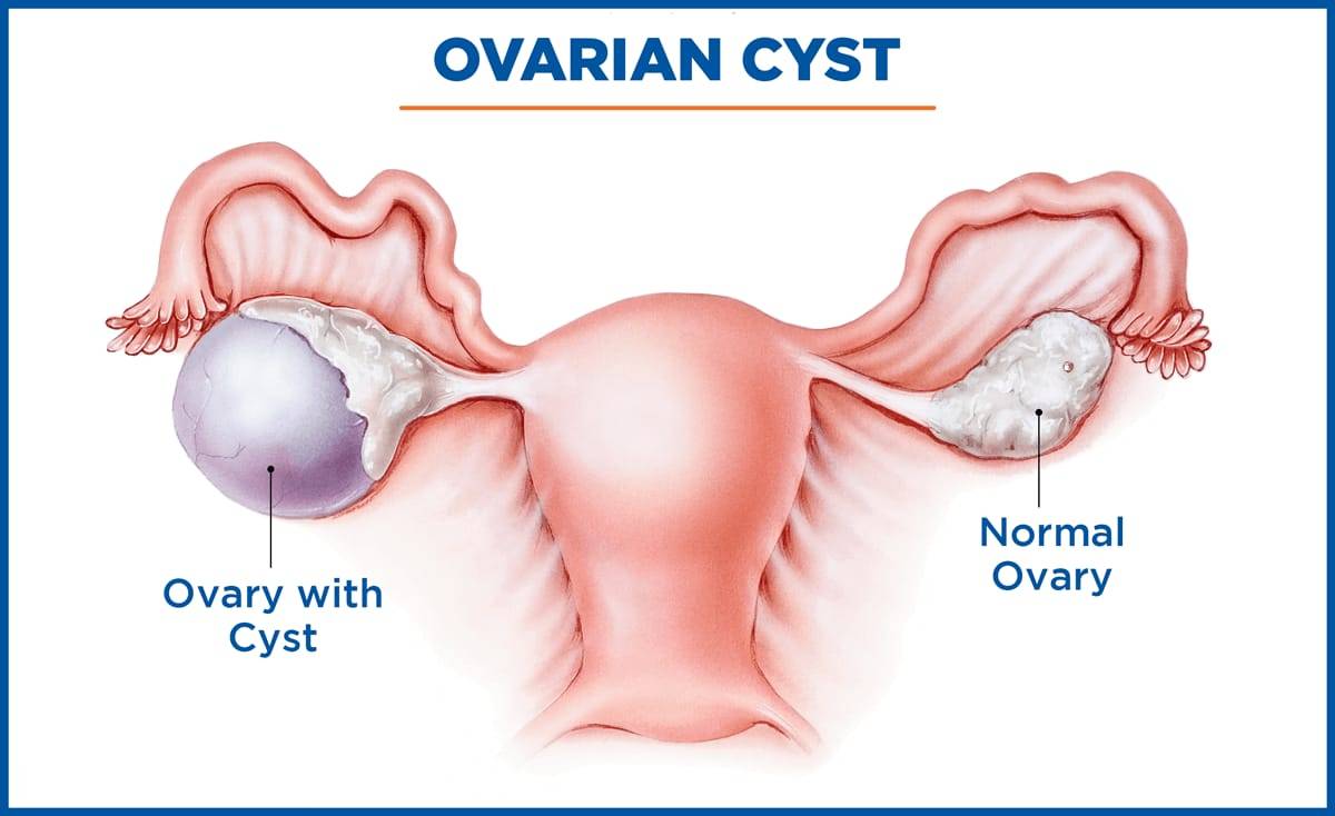 Causes Symptoms And Treatment Of Ovarian Cyst