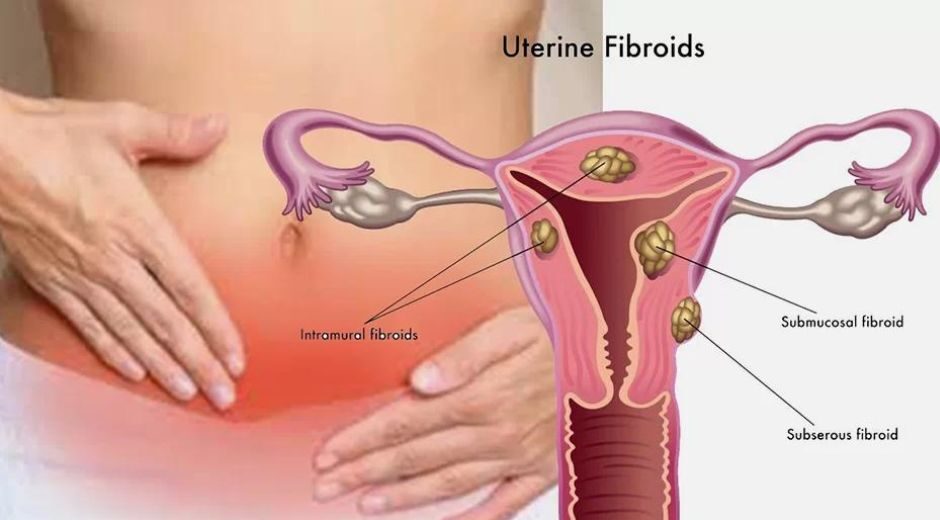 submucosal fibroids