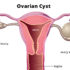 Best Treatment For Ovarian Cancer in Mumbai