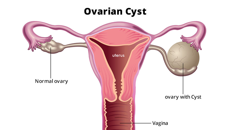 Best Treatment For Ovarian Cancer in Mumbai