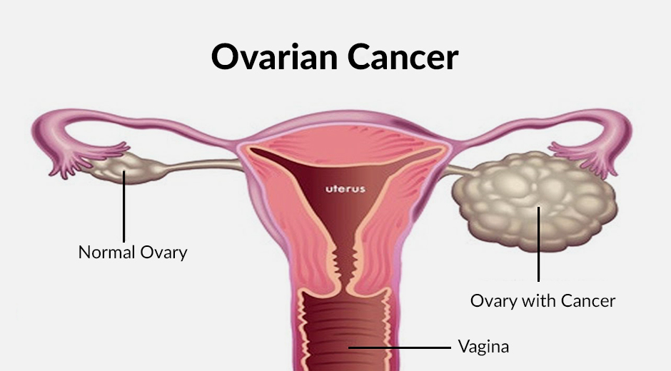 Best Treatment For Ovarian Cancer Screening