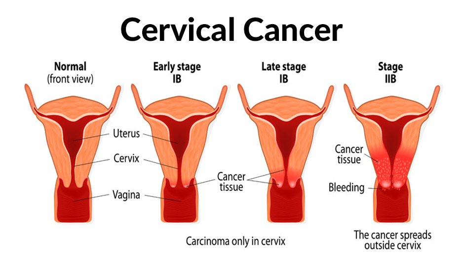 Best Treatment For Cervical Cancer Screening