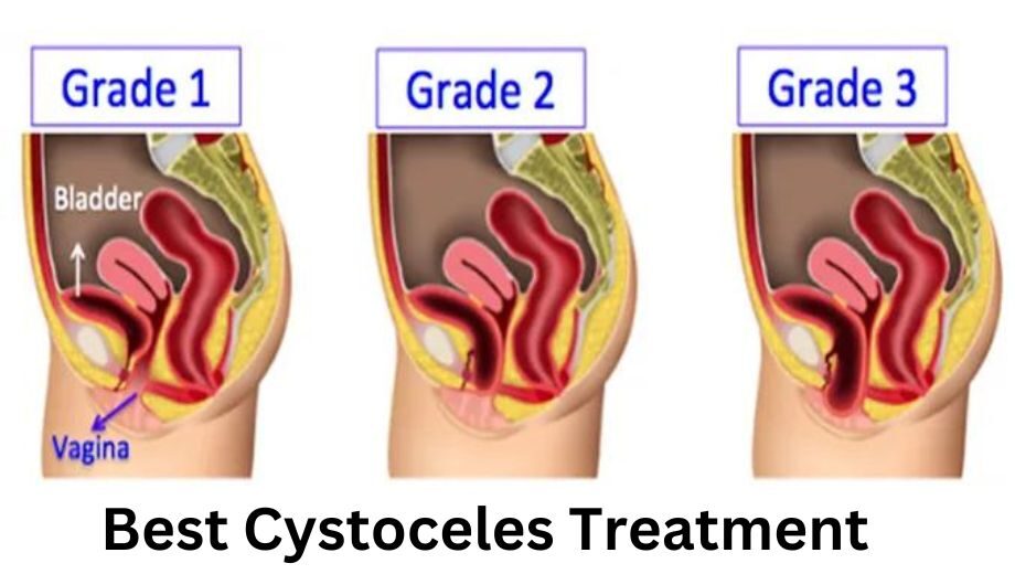 Best Cystoceles Treatment in Mumbai