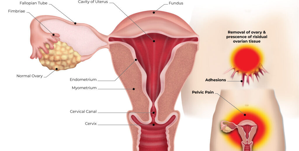 Ovarian_Remnant_Syndrome