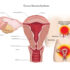 Ovarian_Remnant_Syndrome