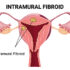 Intramural Fibroids