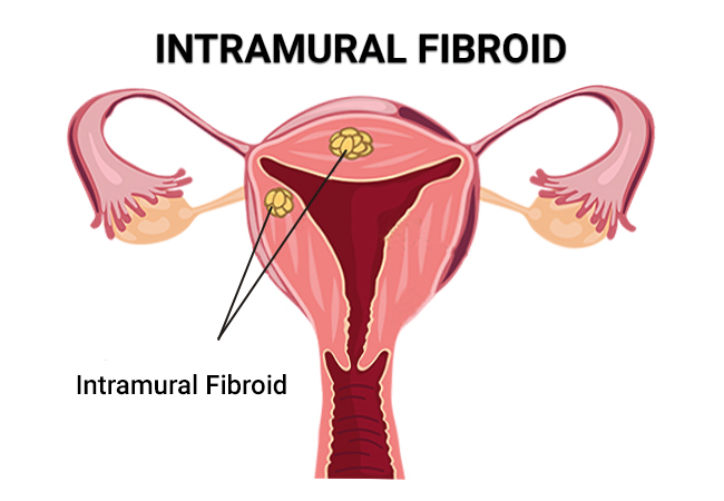 Intramural Fibroids