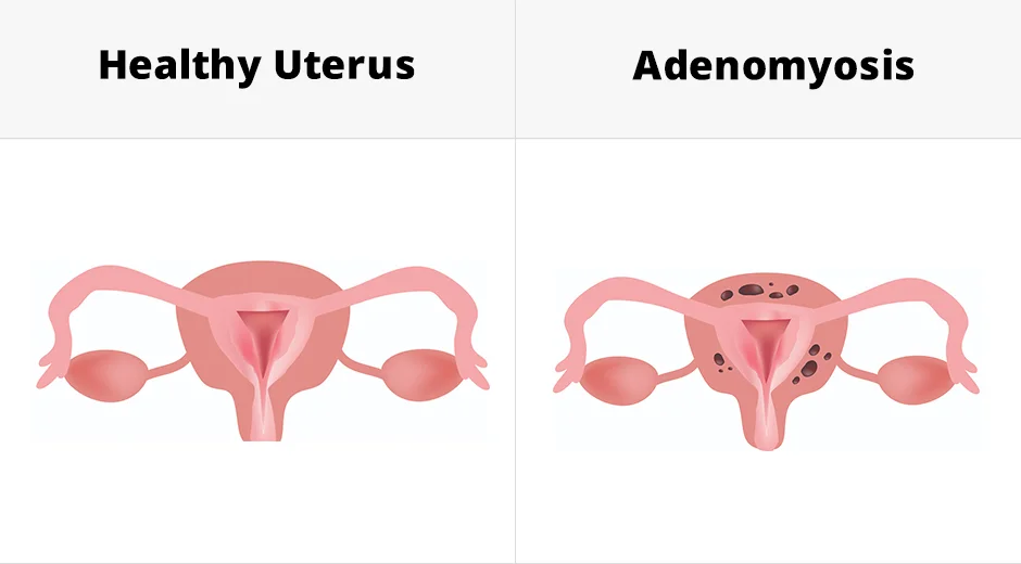 Best Treatment For Adenomyosis in Mumbai
