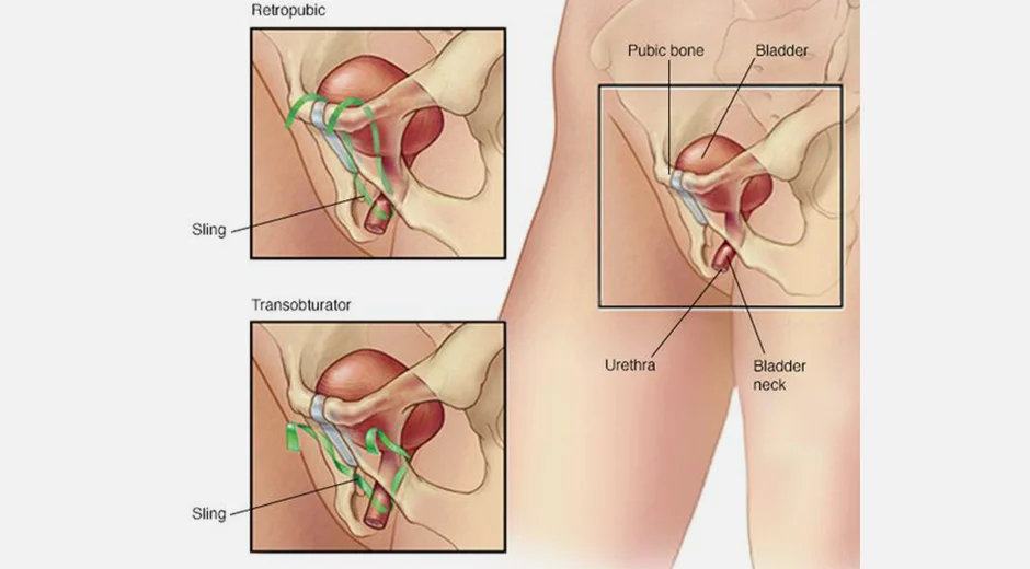 Best Treatment For Stress Urinary Incontinence (SUI) in Mumbai
