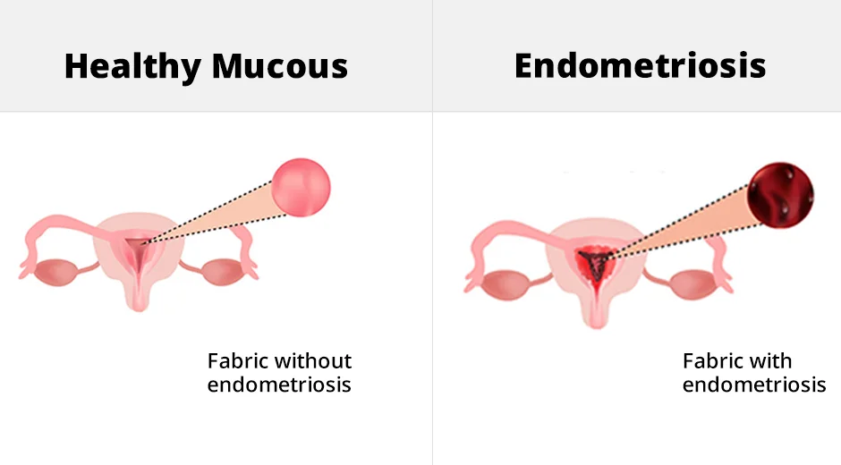 Get treatment from Best Doctor for Endometriosis in Mumbai