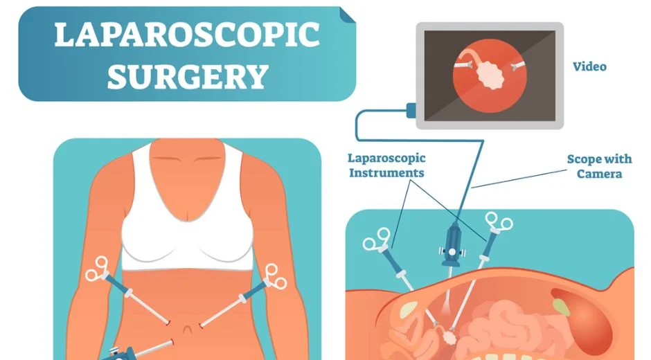 Laparoscopic Surgery For Infertility Treatment