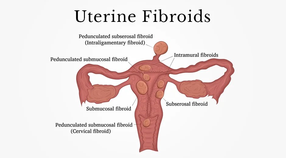 Best Treatment For Uterine Fibroids in Mumbai