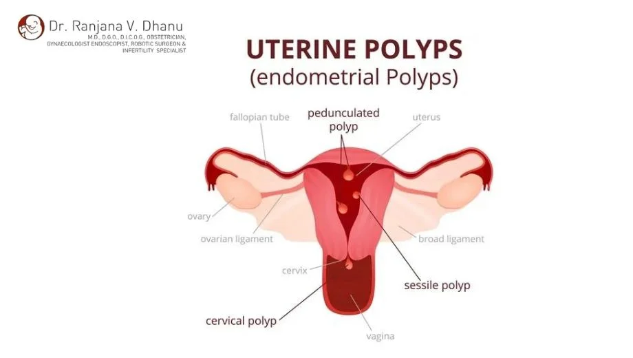 Endometrial polyps- Causes, Symptoms and its treatment