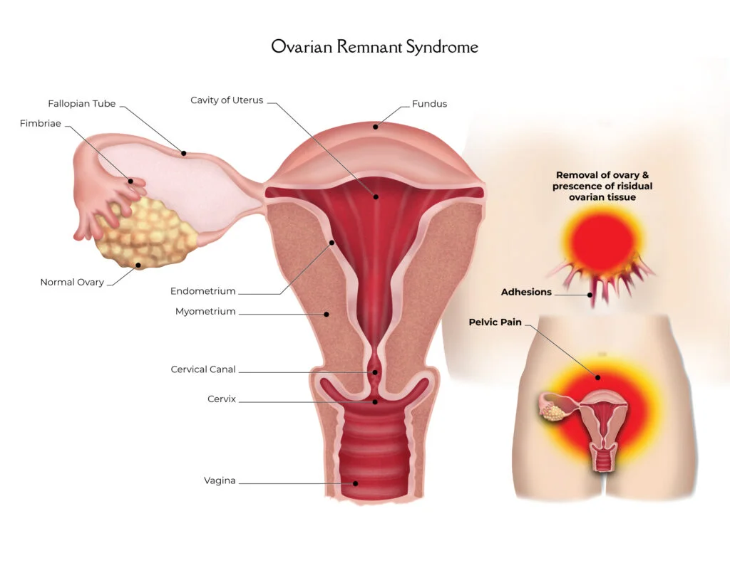 Understanding Ovarian Remnant Syndrome and its Causes, Symptoms, and Treatment